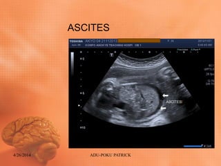 ASCITES
4/26/2014 ADU-POKU PATRICK
 