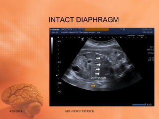 INTACT DIAPHRAGM
4/26/2014 ADU-POKU PATRICK
 
