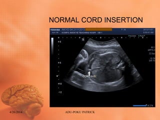 NORMAL CORD INSERTION
4/26/2014 ADU-POKU PATRICK
 