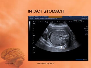 INTACT STOMACH
4/26/2014 ADU-POKU PATRICK
 