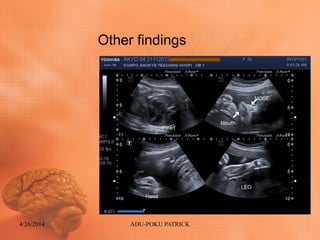 Other findings
4/26/2014 ADU-POKU PATRICK
 