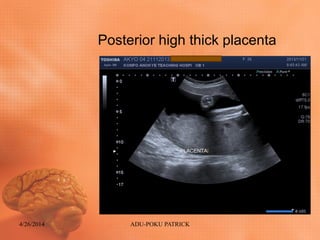 Posterior high thick placenta
4/26/2014 ADU-POKU PATRICK
 