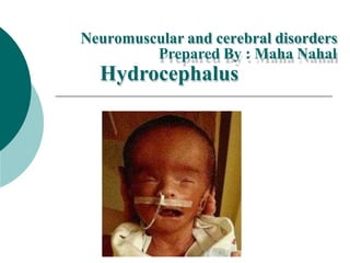 Neuromuscular and cerebral disorders
Prepared By : Maha Nahal
Hydrocephalus
 