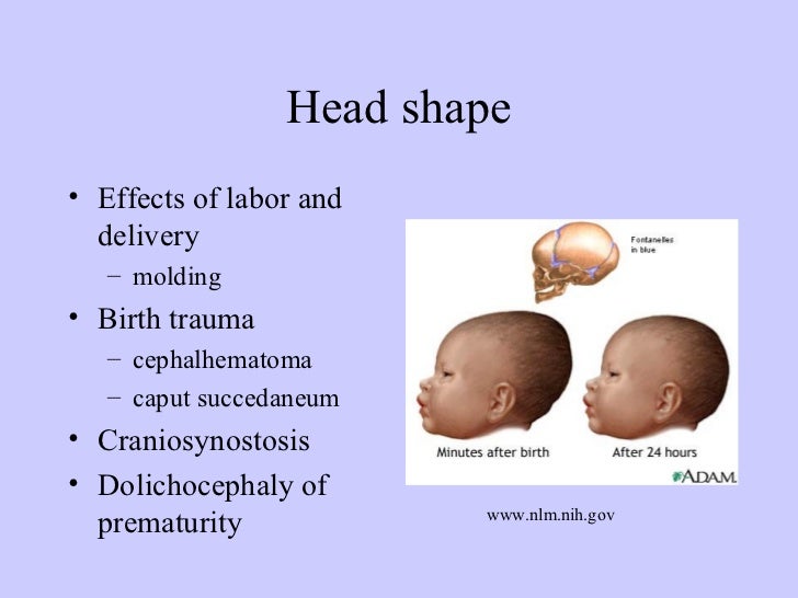 Hydrochephalus