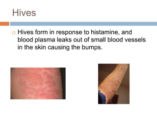 HivesHives form in response to histamine, and blood plasma leaks out of small blood vessels in the skin causing the bumps.