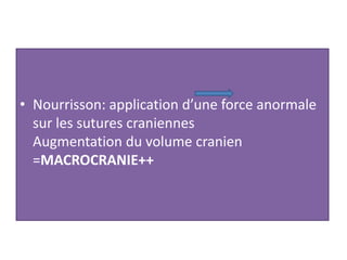 • Nourrisson: application d’une force anormale
sur les sutures craniennes
Augmentation du volume cranien
=MACROCRANIE++
 