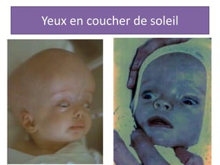 Yeux en coucher de soleil
 