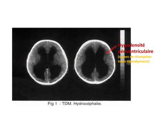 Hypodensité
périventriculaire
(signes de résorption
trans épendymaire)
 