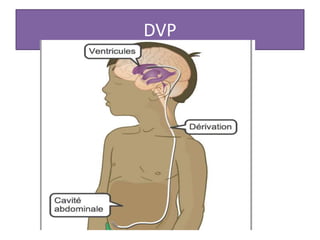 DVP
 