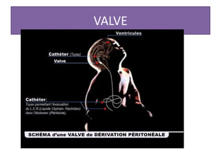 VALVE
 