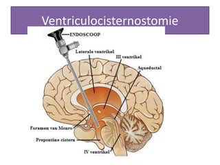 Ventriculocisternostomie
 