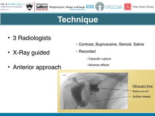 @thearmclinic
• 3 Radiologists
• X-Ray guided
• Anterior approach
• Contrast, Bupivacaine, Steroid, Saline
• Recorded
- Capsular rupture
- Adverse effects
Technique
 