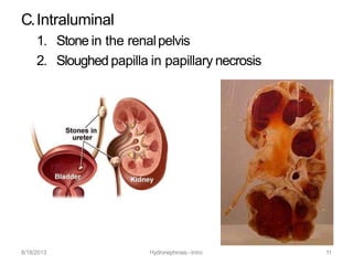 C.Intraluminal
1. Stone in the renalpelvis
2. Sloughed papilla in papillary necrosis
8/18/2013 Hydronephrosis -Intro 11
 