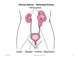 8/18/2013 Hydronephrosis -Intro 3
 