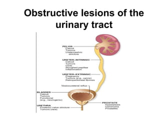 Obstructive lesions of the
urinary tract
 