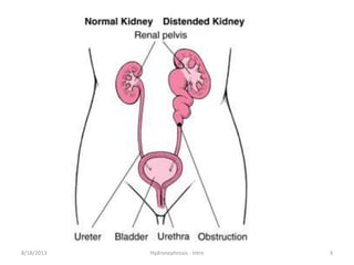 8/18/2013 Hydronephrosis - Intro 3
 