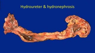 Hydroureter & hydronephrosis
 