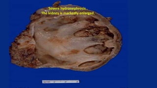 Severe hydronephrosis .
The kidney is markedly enlarged.
 