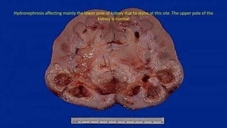 Hydronephrosis affecting mainly the lower pole of kidney due to stone at this site .The upper pole of the
kidney is normal
 