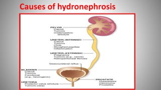 Causes of hydronephrosis
 