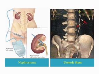 Nephrostomy Ureteric Stent
 