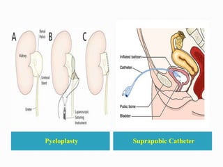 Pyeloplasty Suprapubic Catheter
 