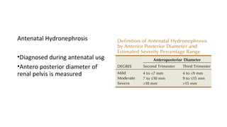 Antenatal Hydronephrosis
•Diagnosed during antenatal usg
•Antero posterior diameter of
renal pelvis is measured
 