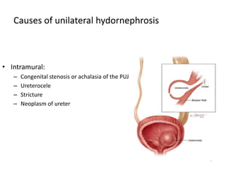 Causes of unilateral hydornephrosis
• Intramural:
– Congenital stenosis or achalasia of the PUJ
– Ureterocele
– Stricture
– Neoplasm of ureter
11
 