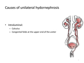 Causes of unilateral hydornephrosis
• Intraluminal:
– Calculus
– Congenital folds at the upper end of the ureter
12
 