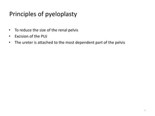 Principles of pyeloplasty
• To reduce the size of the renal pelvis
• Excision of the PUJ
• The ureter is attached to the most dependent part of the pelvis
29
 
