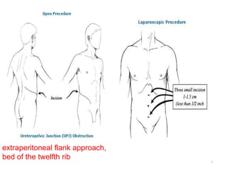 31
extraperitoneal flank approach,
bed of the twelfth rib
 