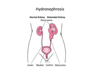 Hydronephrosis
4
 