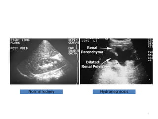 5
Normal kidney Hydronephrosis
 