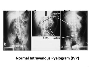 Normal Intravenous Pyelogram (IVP)
6
 