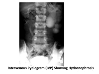 Intravenous Pyelogram (IVP) Showing Hydronephrosis
7
 