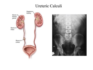 Ureteric Calculi
 