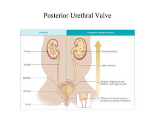 Posterior Urethral Valve
 