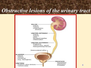 Obstructive lesions of the urinary tract
8
 