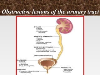 Obstructive lesions of the urinary tract
 