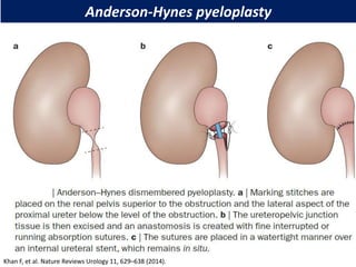 Anderson-Hynes pyeloplasty
Khan F, et al. Nature Reviews Urology 11, 629–638 (2014).
 