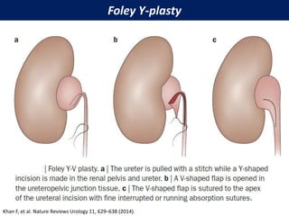 Foley Y-plasty
Khan F, et al. Nature Reviews Urology 11, 629–638 (2014).
 