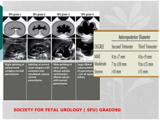 HYDRONEPHROSIS.pdf antenatal paediatric | PDF