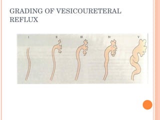 Hydronephrosis Dr Lokku | PPT