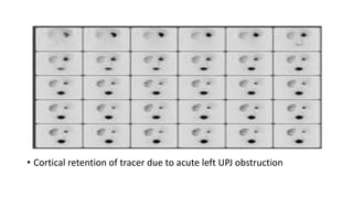 • Cortical retention of tracer due to acute left UPJ obstruction
 
