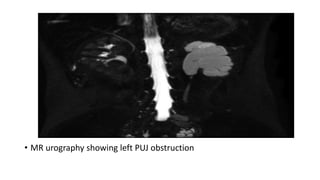• MR urography showing left PUJ obstruction
 