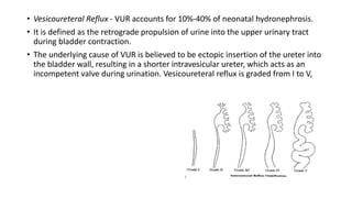 • Vesicoureteral Reflux - VUR accounts for 10%-40% of neonatal hydronephrosis.
• It is defined as the retrograde propulsion of urine into the upper urinary tract
during bladder contraction.
• The underlying cause of VUR is believed to be ectopic insertion of the ureter into
the bladder wall, resulting in a shorter intravesicular ureter, which acts as an
incompetent valve during urination. Vesicoureteral reflux is graded from I to V,
 