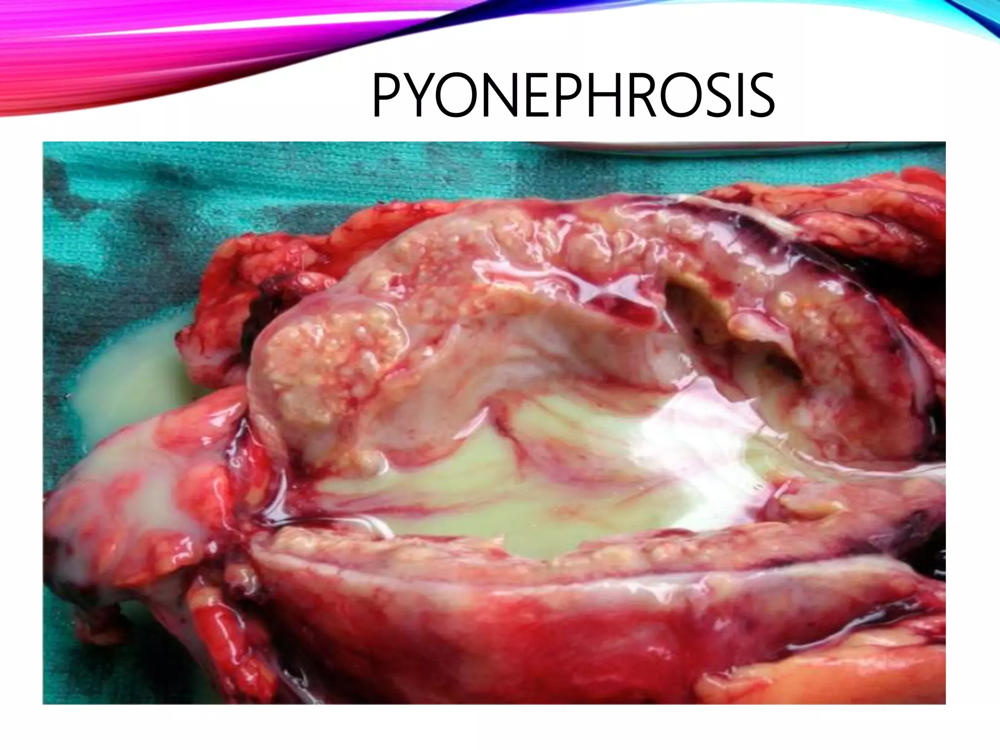 PYONEPHROSIS
 