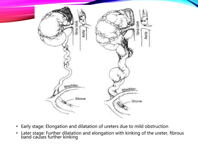 Hydronephrosis and Pyonephrosis | PPTX | Digestive Disorders | Diseases ...