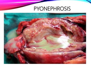 PYONEPHROSIS
 