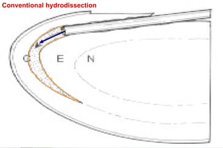 Water Stream Dissection HYDROPROCEDURES include hydrodissection nad hydrodelineation | PPTX